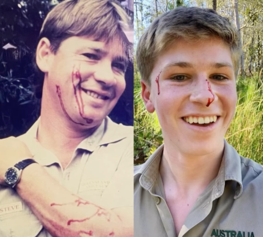 Robert Irwin Gets Bitten In The Face By Same Species Snake Which Attacked Late Dad Steve Irwin