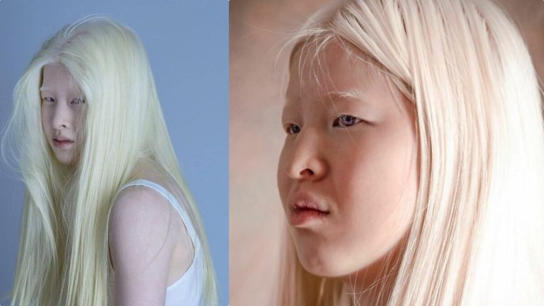 RecordGirl Abandoned By Parents For Her Looks Wants To Prove The World Wrong – Now She Models For Vogue