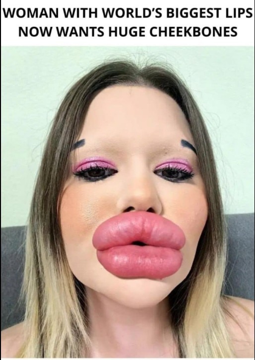 25-Year-Old Bulgarian Woman Has More Than 27 Procedures To Have The Biggest Lips In The World