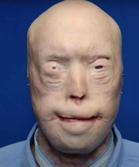 Patrick Hardison Received A New Face After Third-degree Burns, This Is Him Today