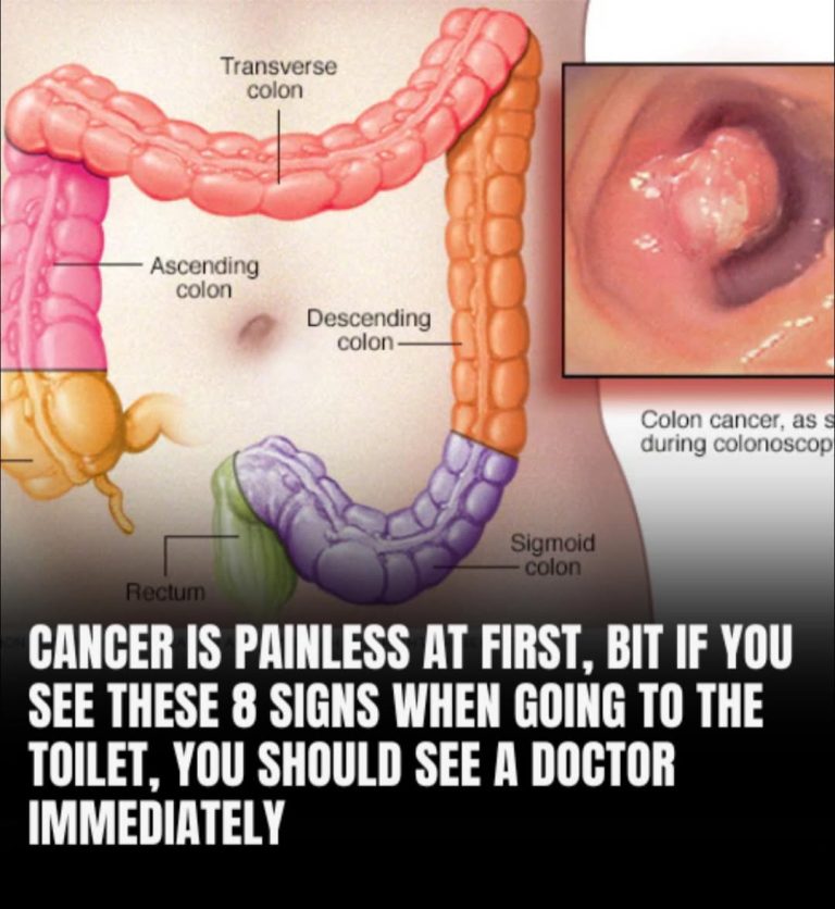 Poop and Colon Cancer: Warning Signs To Look For And When To Seek For Help