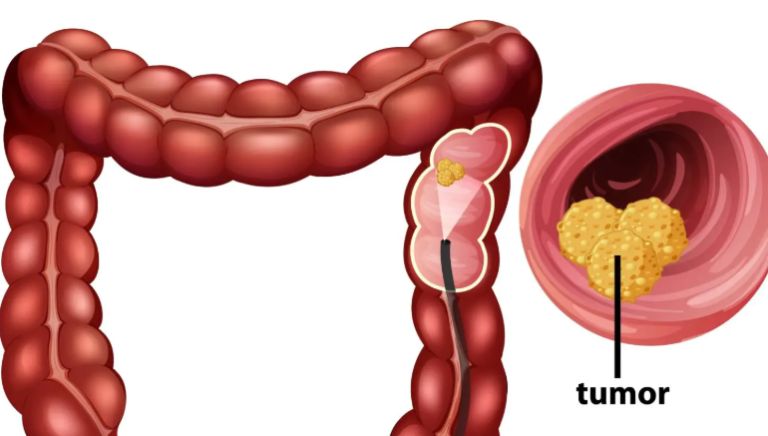 How Your Bowel Movements Reveal Clues About Colon Cancer