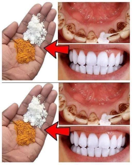 Natural Remedies with Cloves and Bay Leaves for a Brighter Smile