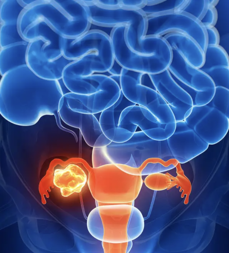 Subtle symptoms of ovarian cancer that shouldn’t be ignored