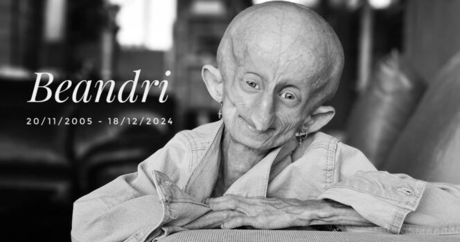 Beandri Booysen: Girl in South Africa with progeria dies