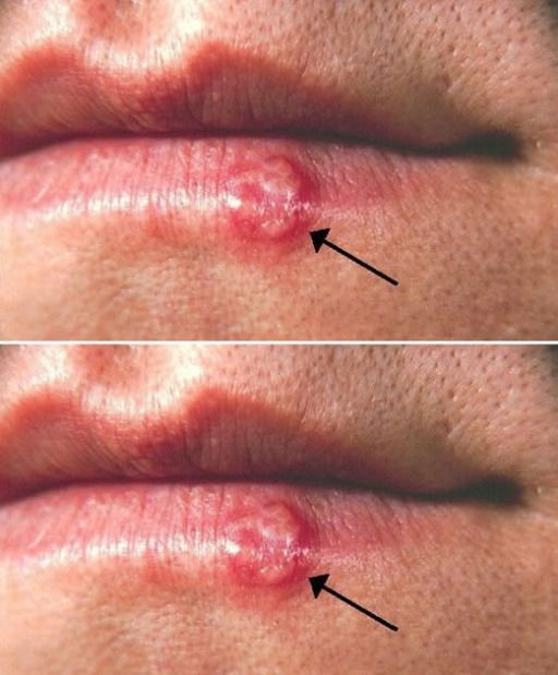 Most People Have Had or Have This Cold Sore Virus, But Very Few Know How to Cure It – Here’s What You Need to Do!