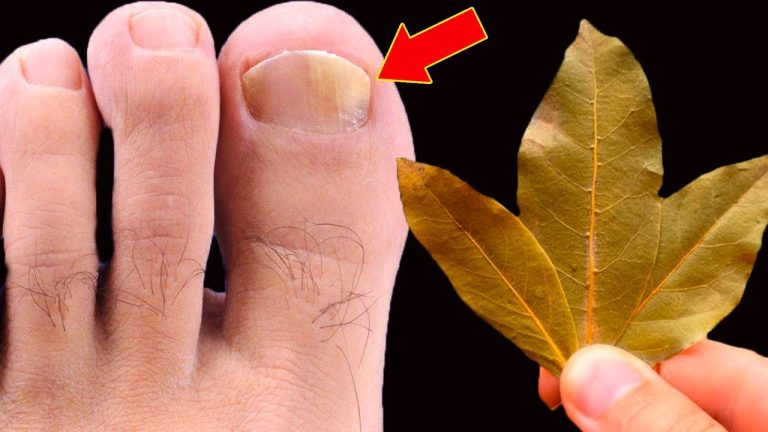 🔥 Eliminate Nail Fungus Instantly! No More Spending Money at the Pharmacy – Try Bay Leaves!